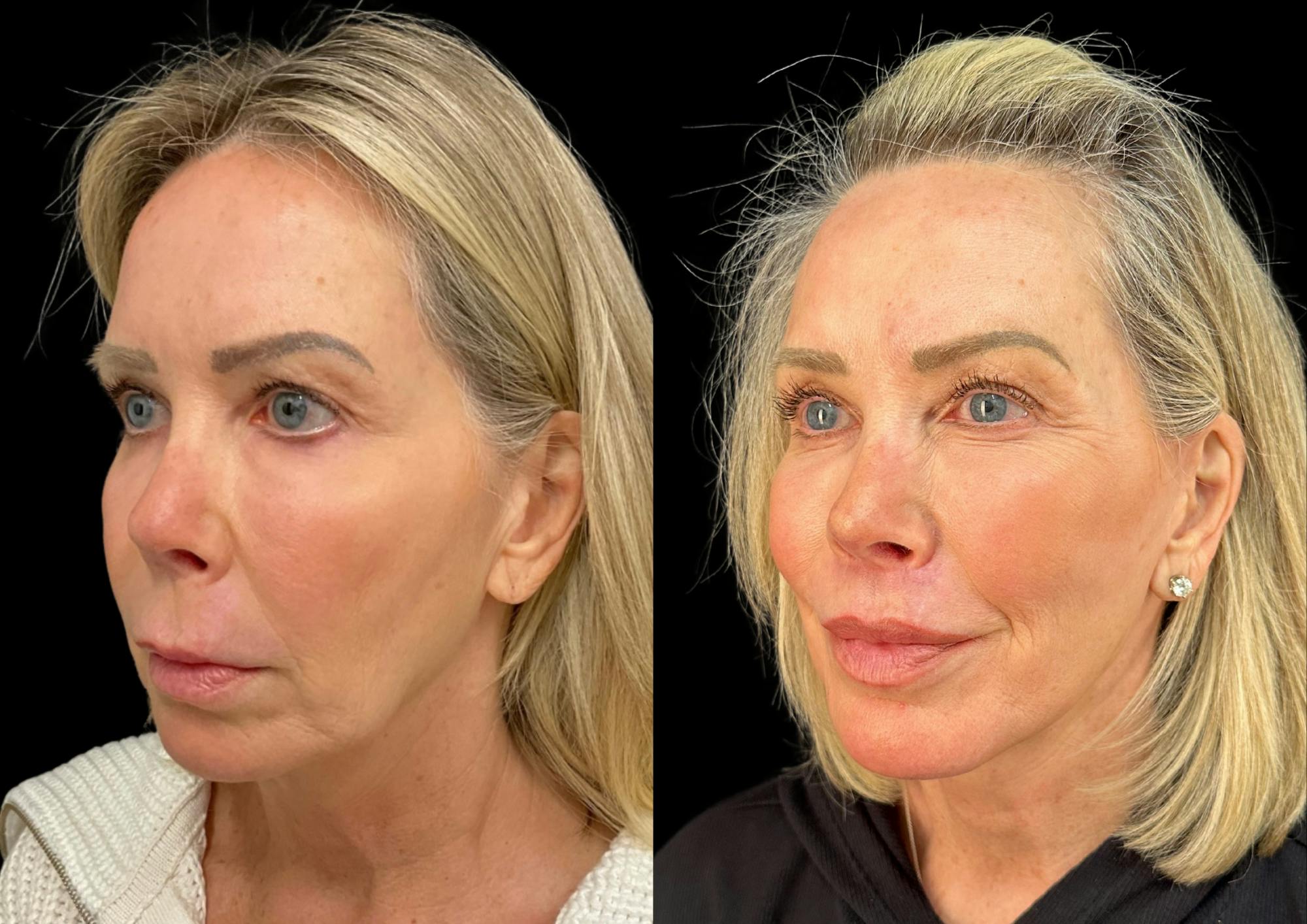 Neck Lift Before & After Gallery - Patient 320535 - Image 3