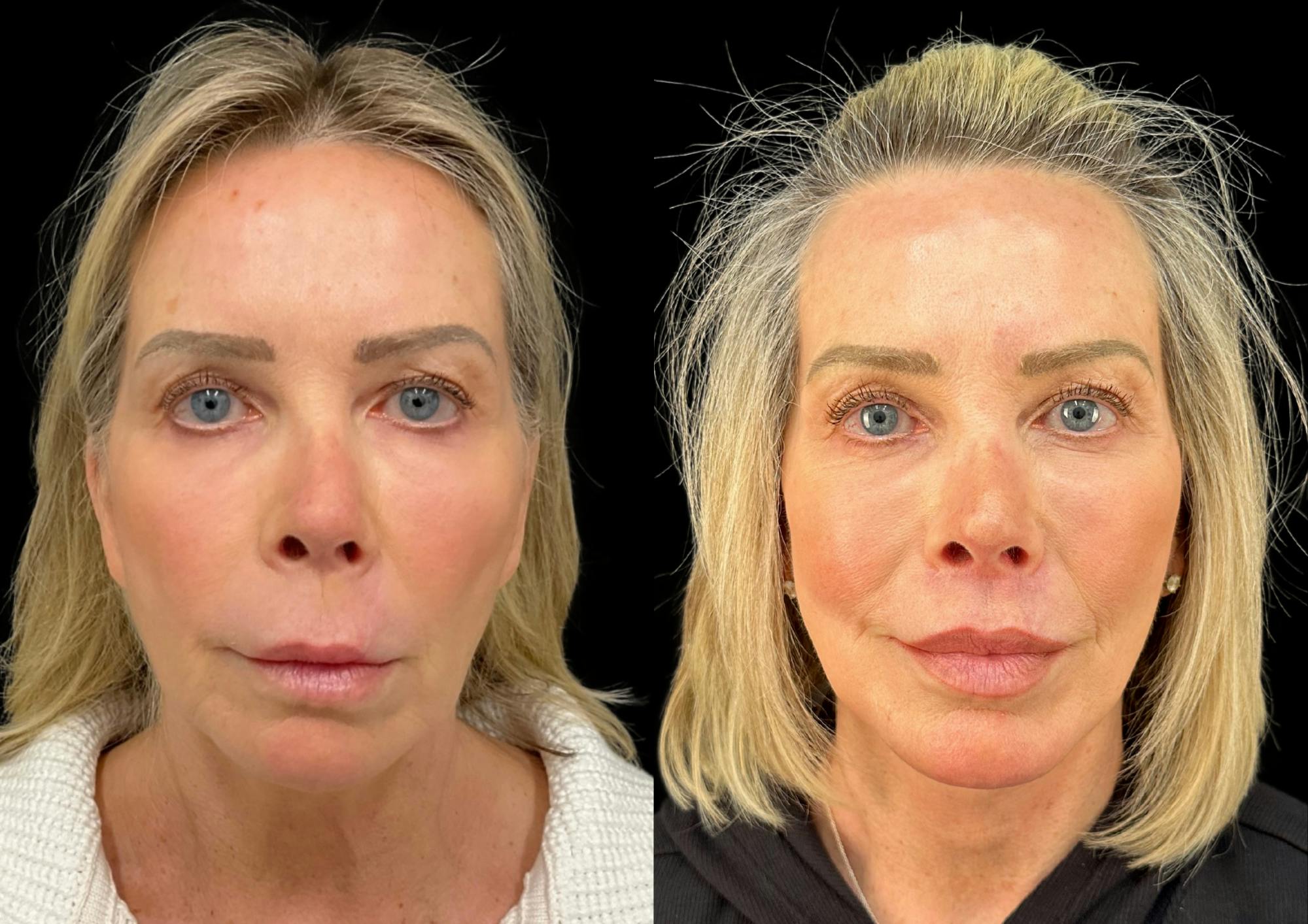 Neck Lift Before & After Gallery - Patient 320535 - Image 4