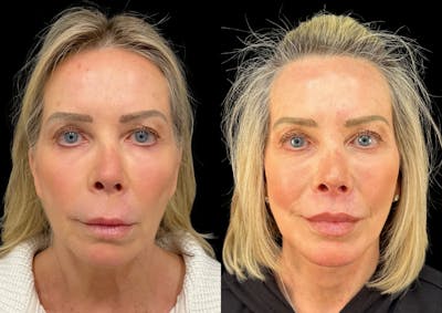 Lip Lift Before & After Gallery - Patient 105240 - Image 1