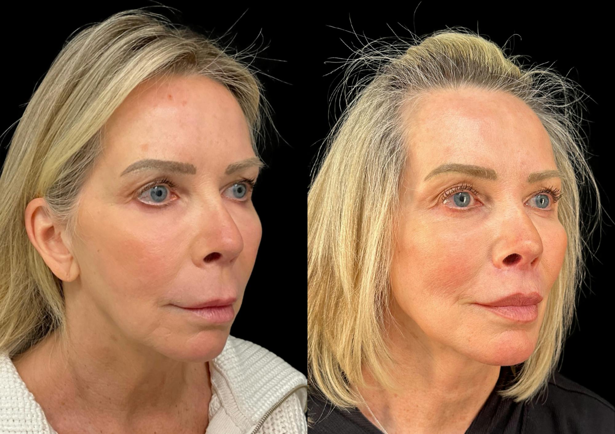Neck Lift Before & After Gallery - Patient 320535 - Image 5