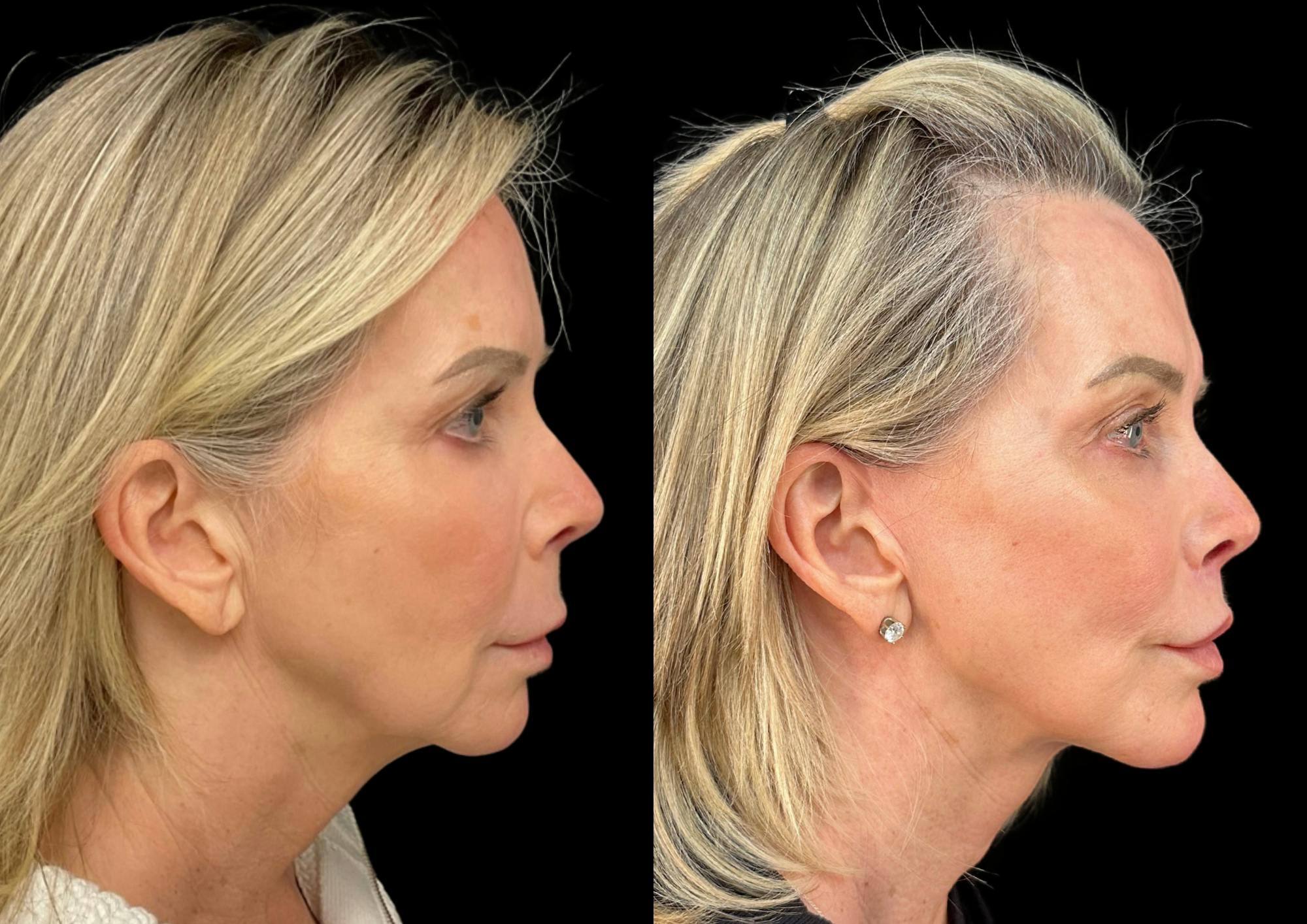 Neck Lift Before & After Gallery - Patient 320535 - Image 6