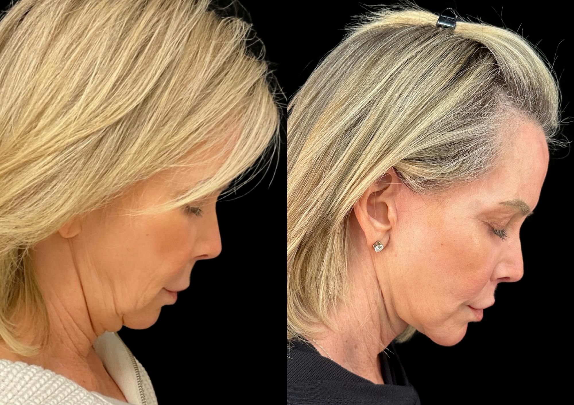 Neck Lift Before & After Gallery - Patient 320535 - Image 7