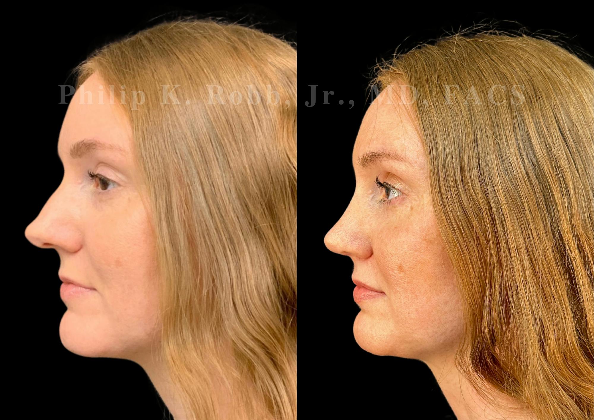 Ultrasonic Rhinoplasty Before & After Gallery - Patient 186041 - Image 5