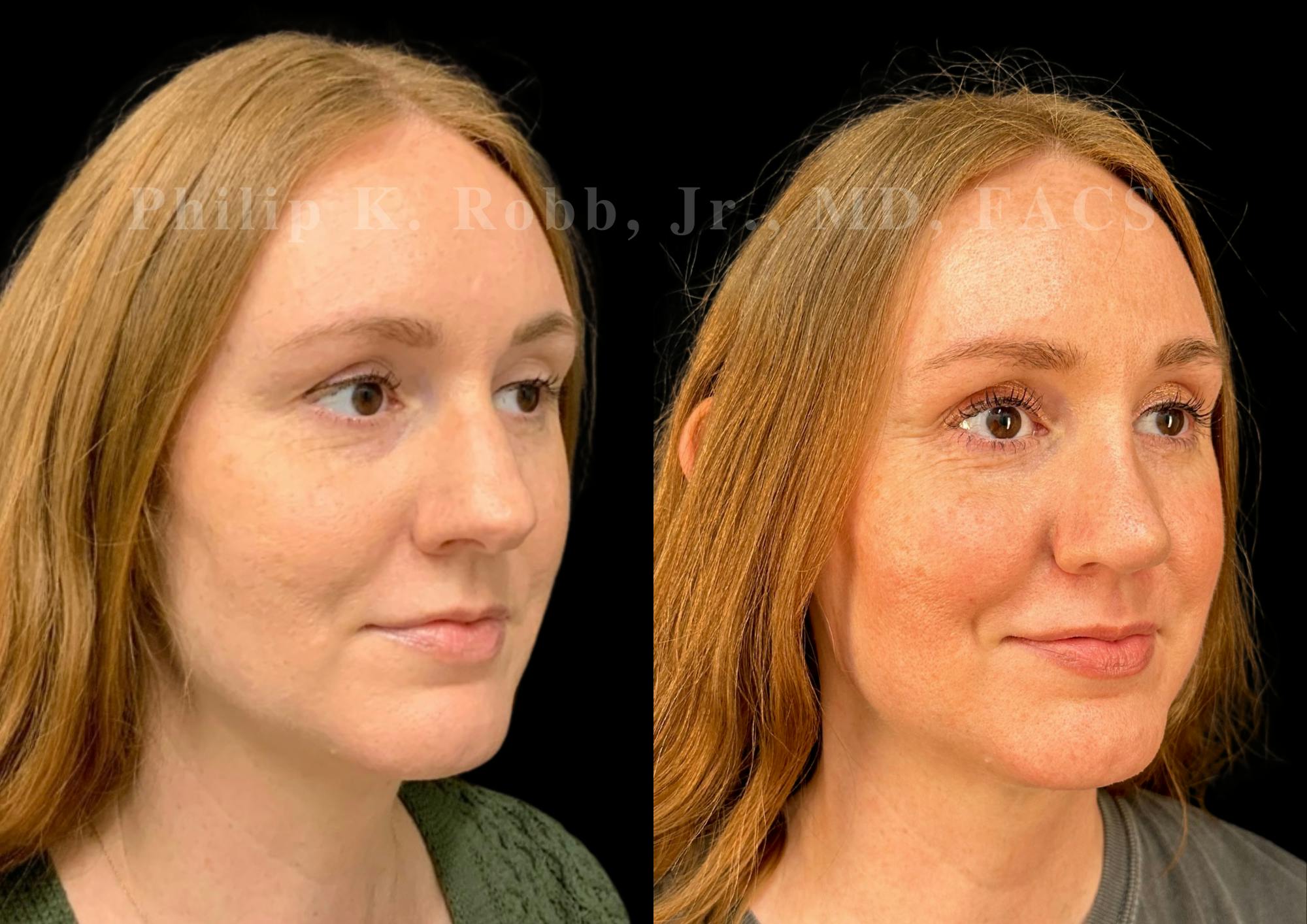 Ultrasonic Rhinoplasty Before & After Gallery - Patient 186041 - Image 2
