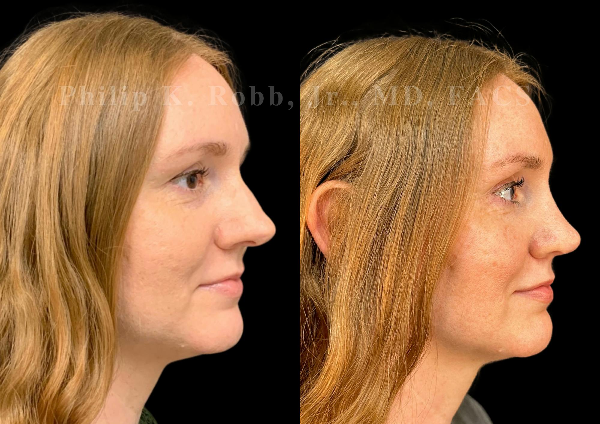 Ultrasonic Rhinoplasty Before & After Gallery - Patient 186041 - Image 1
