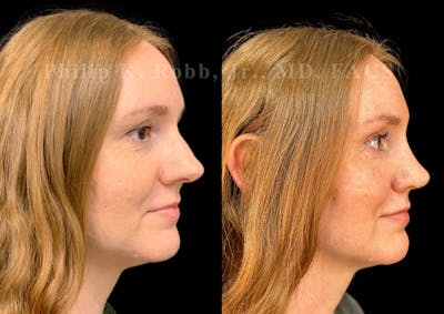 Ultrasonic Rhinoplasty Before & After Gallery - Patient 186041 - Image 1