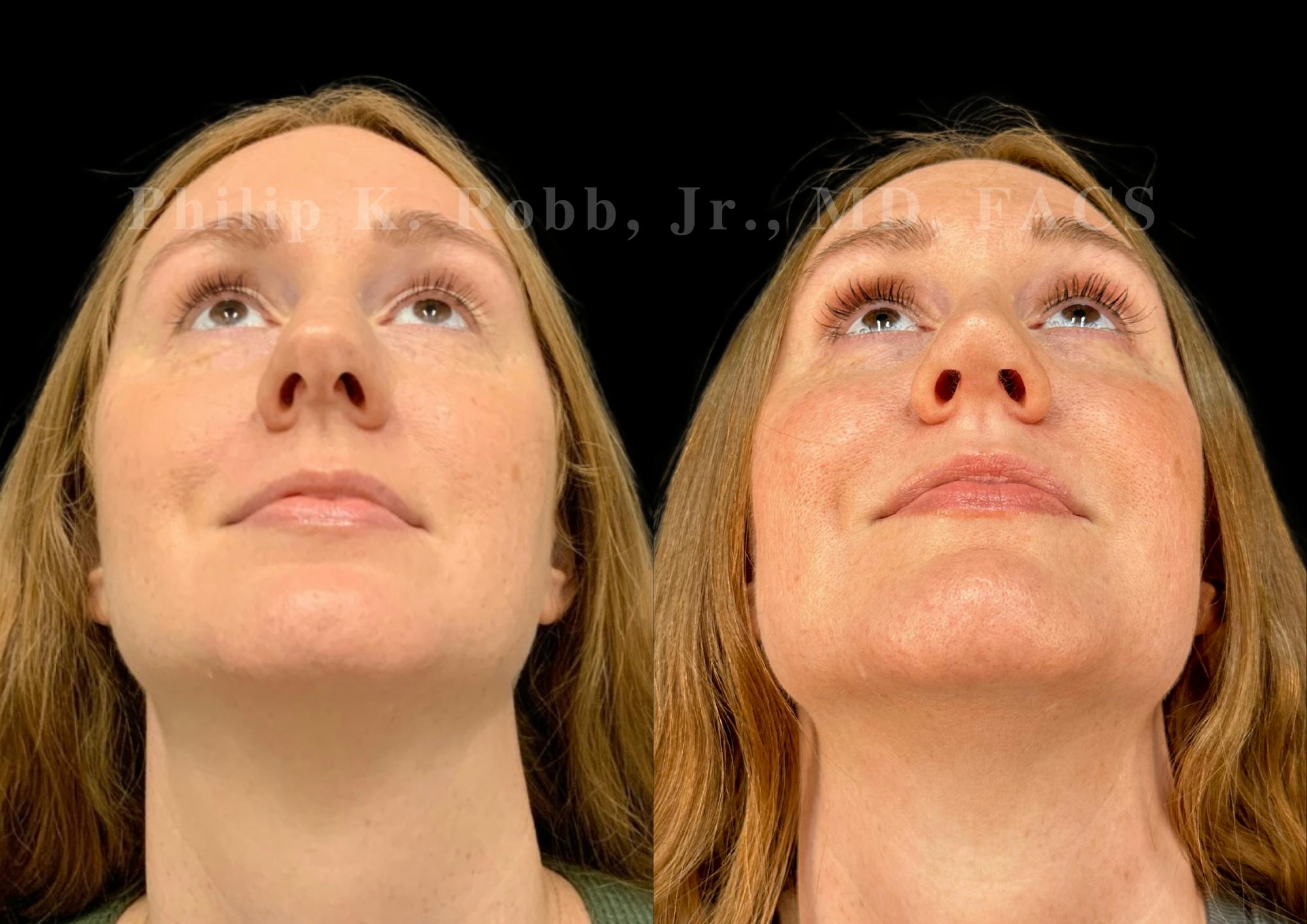 Ultrasonic Rhinoplasty Before & After Gallery - Patient 186041 - Image 6