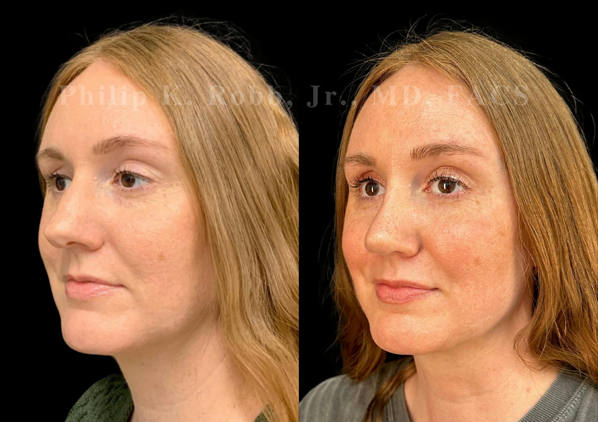 Ultrasonic Rhinoplasty Before & After Gallery - Patient 186041 - Image 4