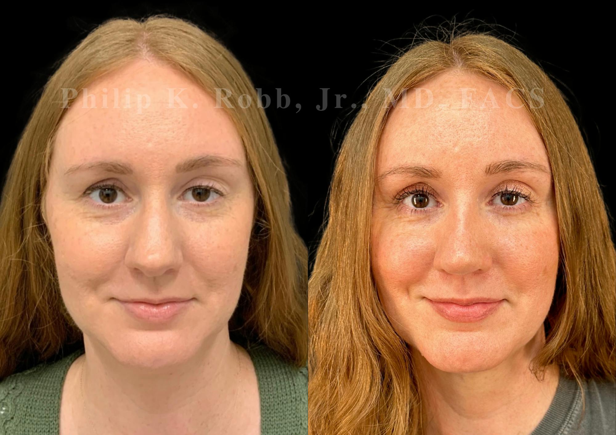 Ultrasonic Rhinoplasty Before & After Gallery - Patient 186041 - Image 3