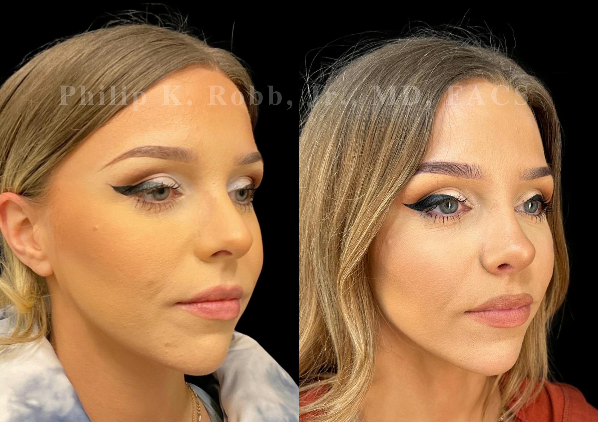 Ultrasonic Rhinoplasty Before & After Gallery - Patient 378972 - Image 2
