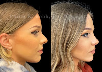Ultrasonic Rhinoplasty Before & After Gallery - Patient 378972 - Image 1