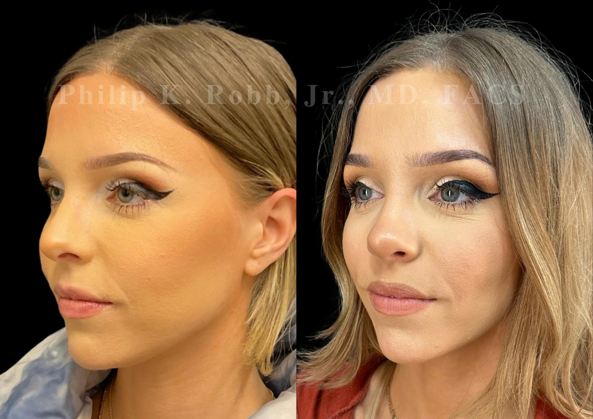 Ultrasonic Rhinoplasty Before & After Gallery - Patient 378972 - Image 4