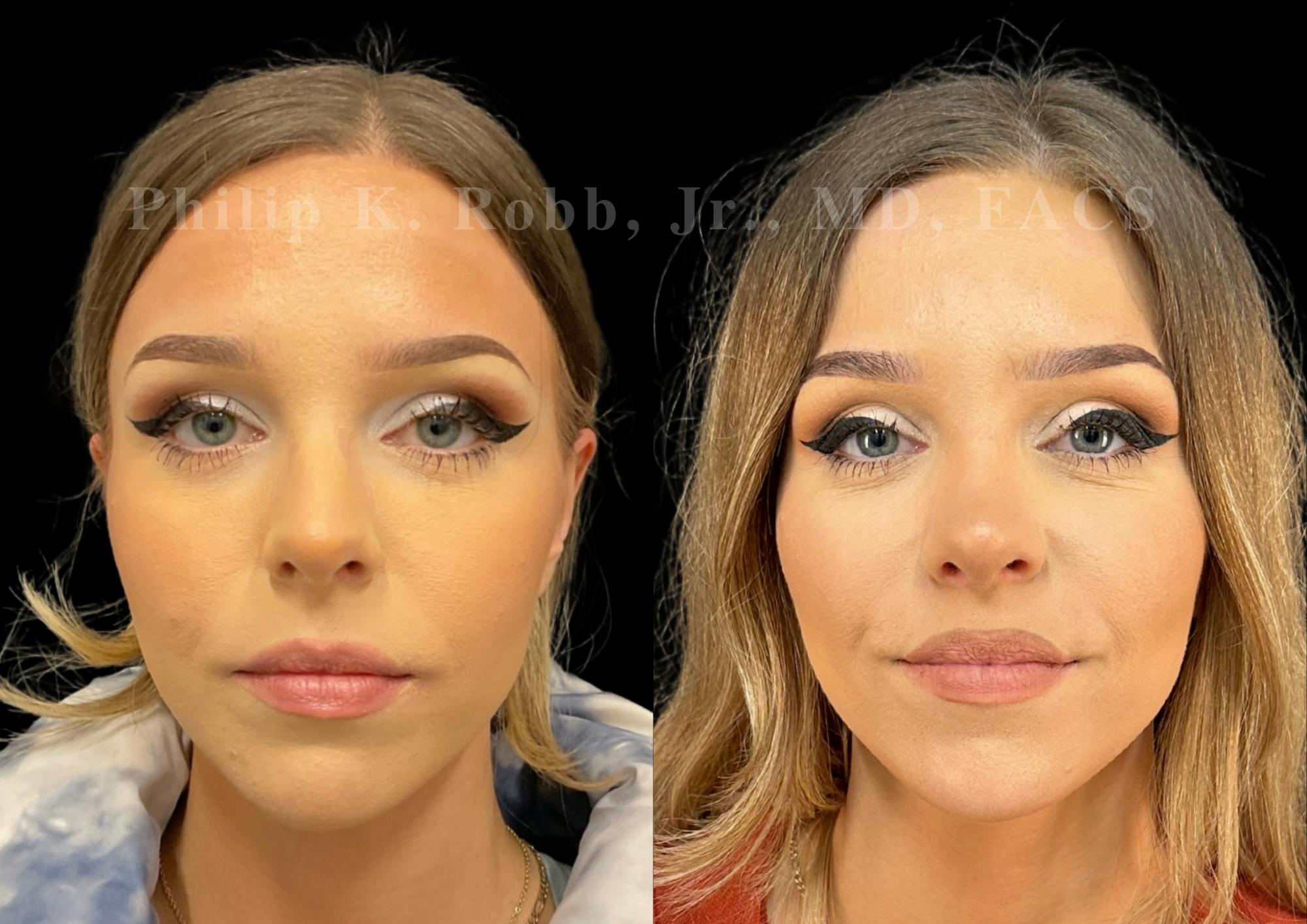 Ultrasonic Rhinoplasty Before & After Gallery - Patient 378972 - Image 3