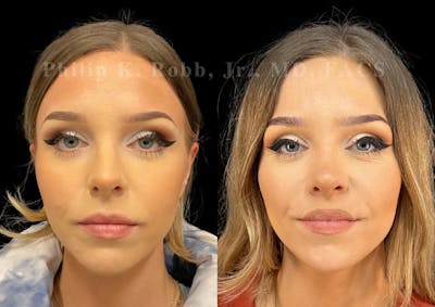 Laser Skin Resurfacing Before & After Gallery - Patient 132273 - Image 1