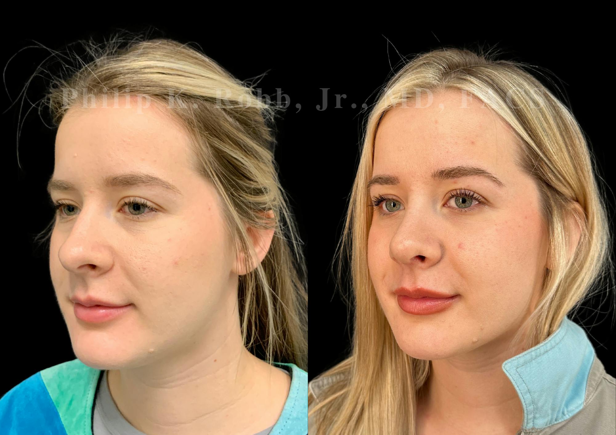 Ultrasonic Rhinoplasty Before & After Gallery - Patient 346924 - Image 4