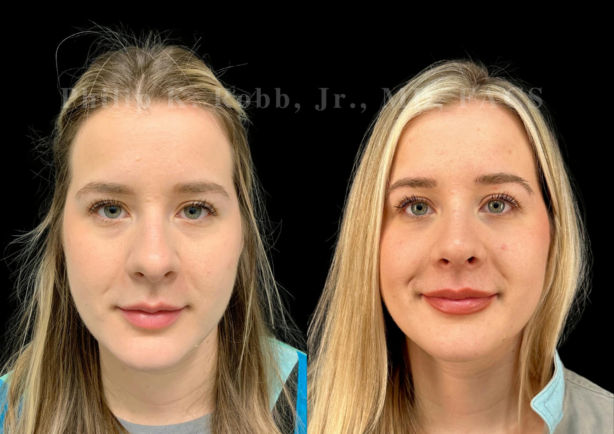 Ultrasonic Rhinoplasty Before & After Gallery - Patient 346924 - Image 3