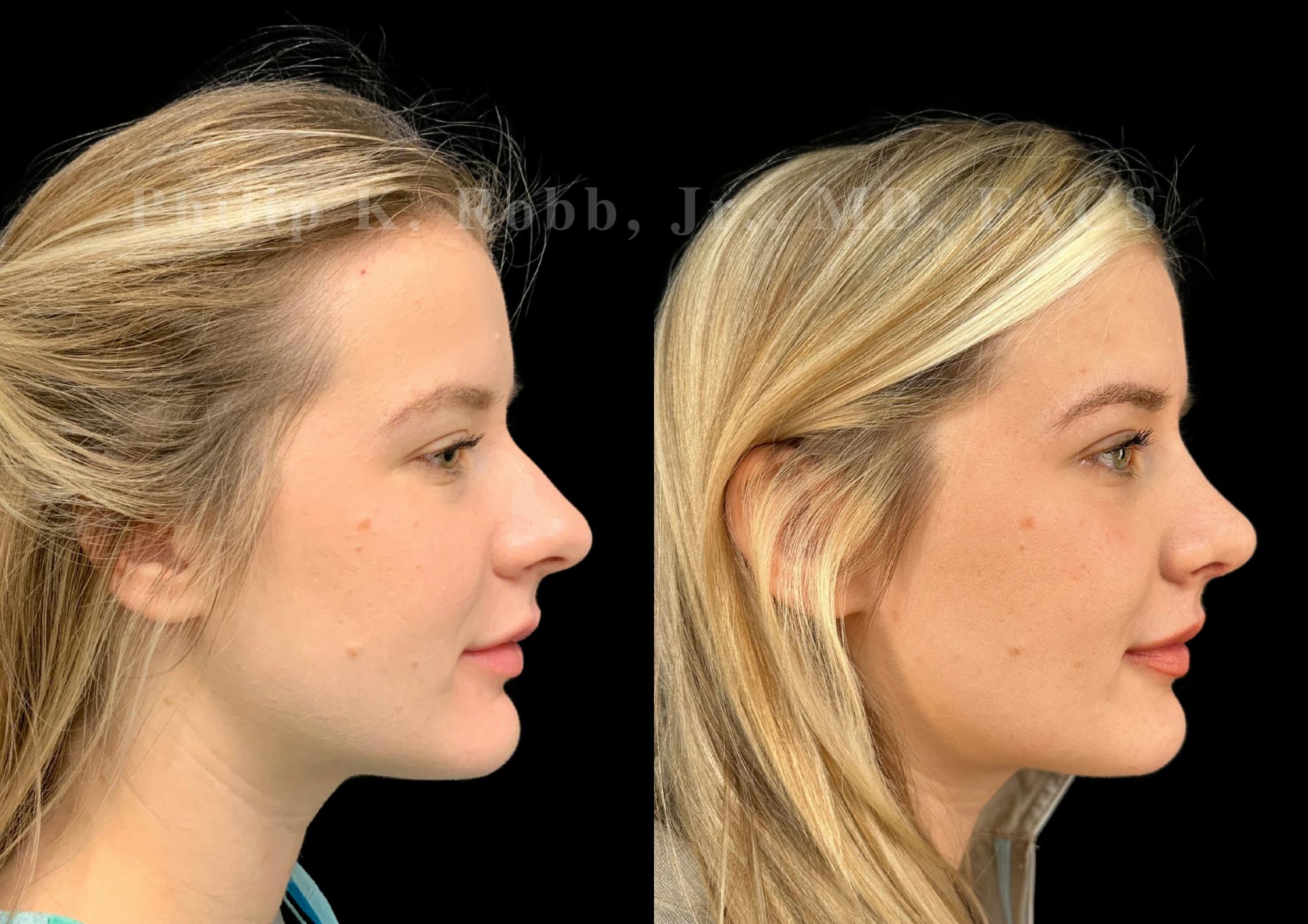 Ultrasonic Rhinoplasty Before & After Gallery - Patient 346924 - Image 1