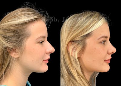 Ultrasonic Rhinoplasty Before & After Gallery - Patient 346924 - Image 1