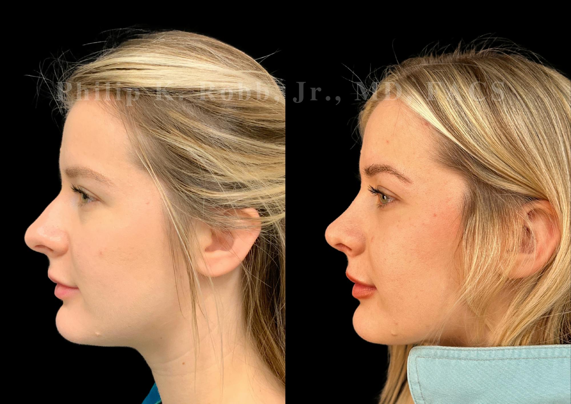 Ultrasonic Rhinoplasty Before & After Gallery - Patient 346924 - Image 5