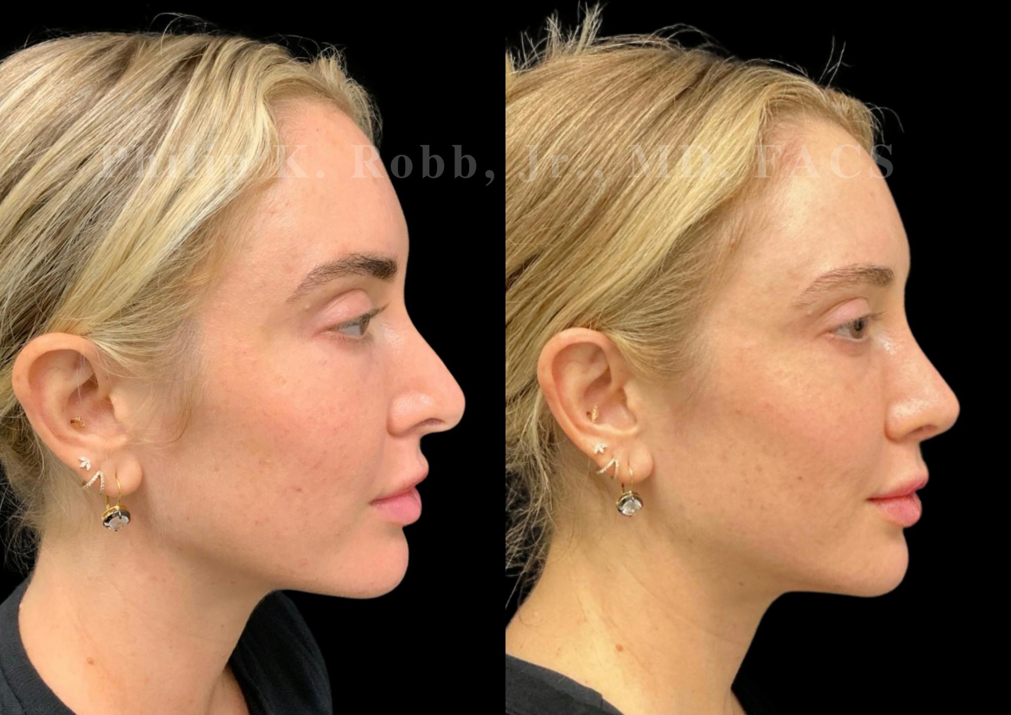 Ultrasonic Rhinoplasty Before & After Gallery - Patient 395748 - Image 1