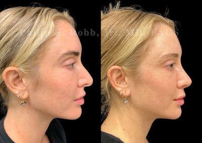 Ultrasonic Rhinoplasty Before & After Gallery - Patient 395748 - Image 1