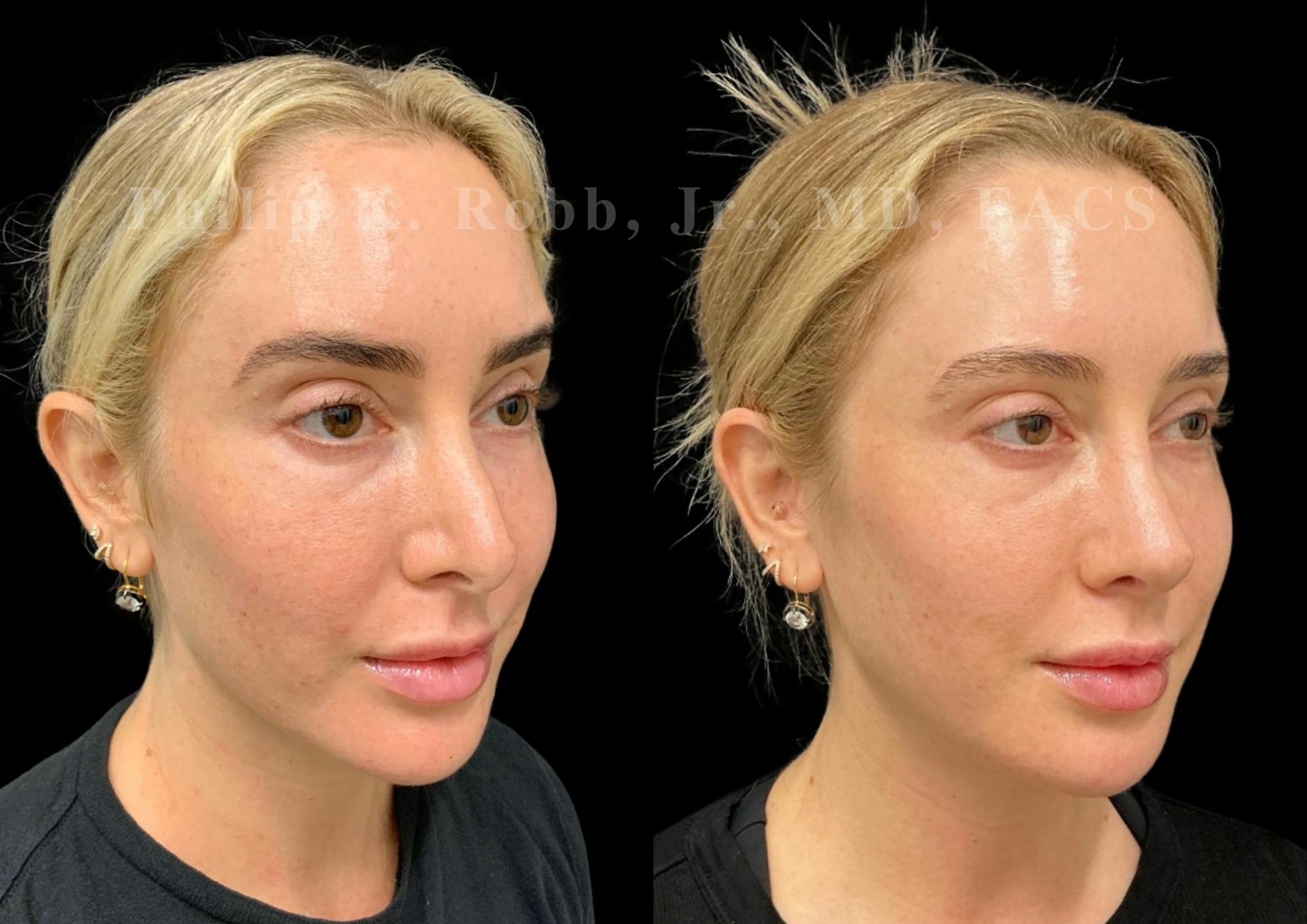 Ultrasonic Rhinoplasty Before & After Gallery - Patient 395748 - Image 2