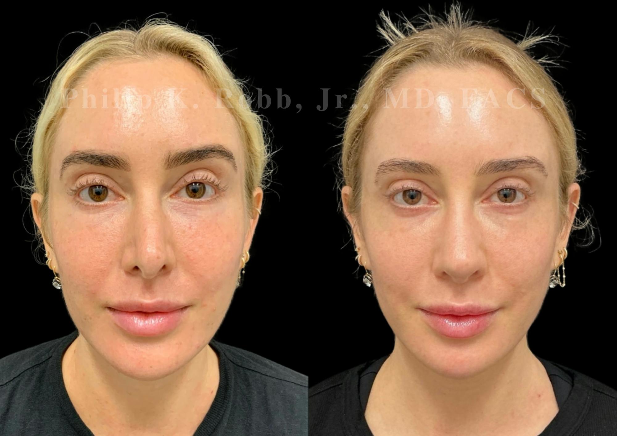 Ultrasonic Rhinoplasty Before & After Gallery - Patient 395748 - Image 3