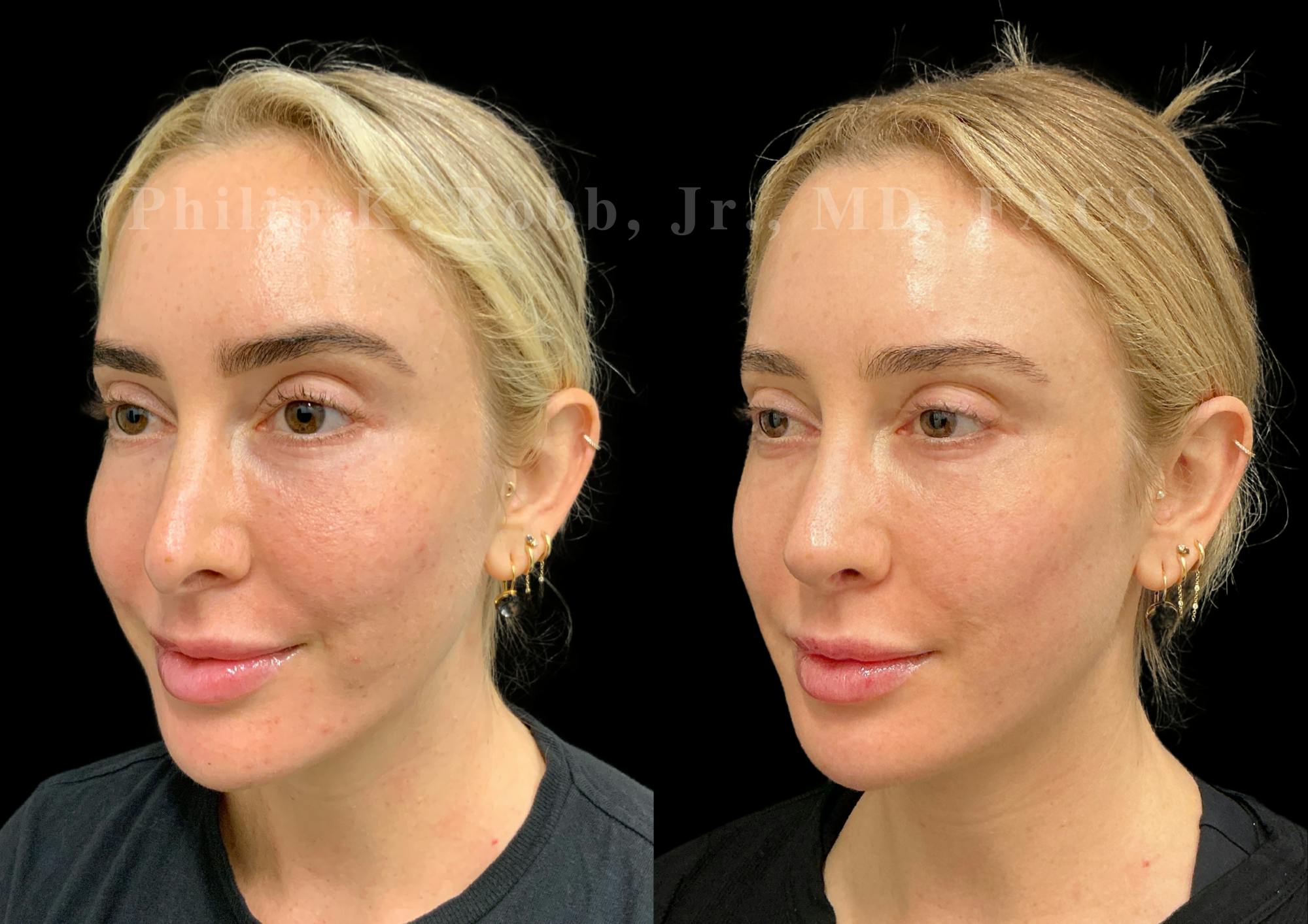 Ultrasonic Rhinoplasty Before & After Gallery - Patient 395748 - Image 4