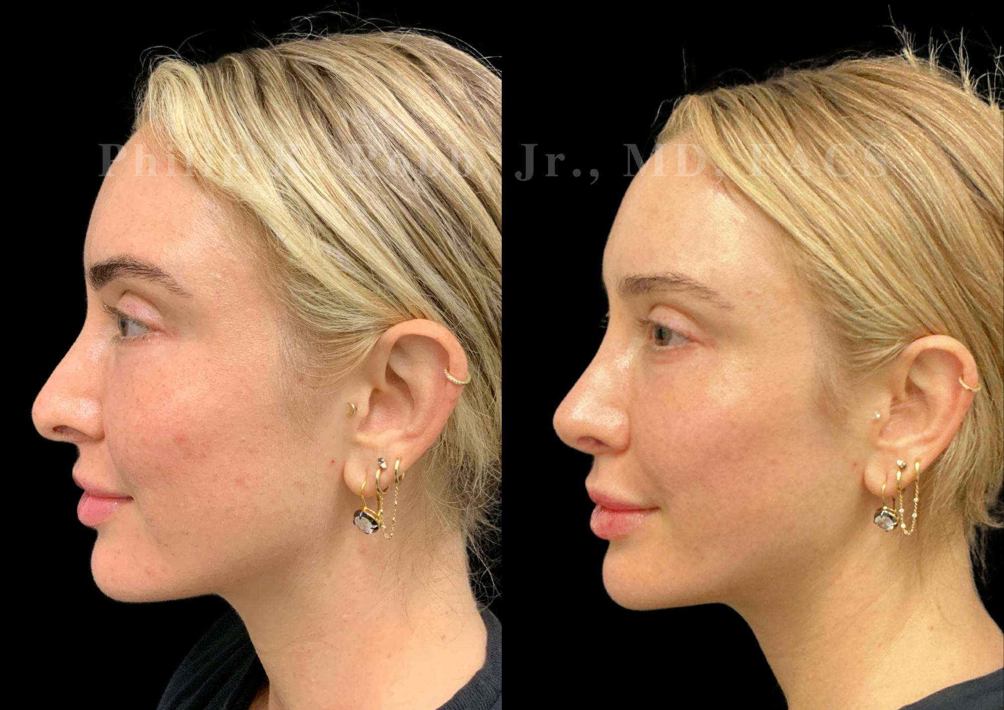 Ultrasonic Rhinoplasty Before & After Gallery - Patient 395748 - Image 5