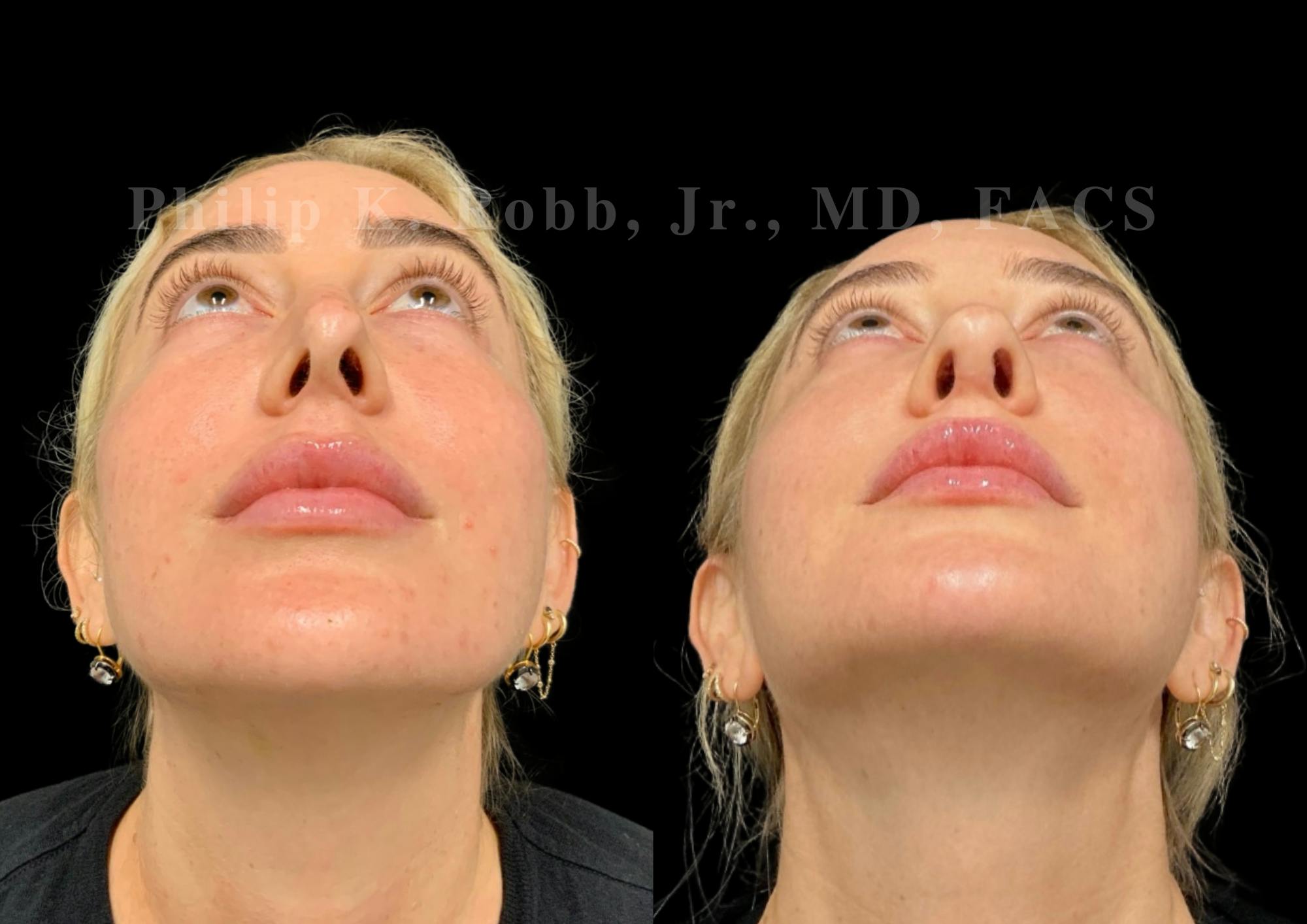 Ultrasonic Rhinoplasty Before & After Gallery - Patient 395748 - Image 6