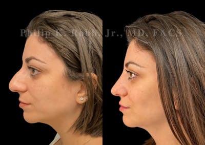 Chin Augmentation Before & After Gallery - Patient 125893 - Image 1