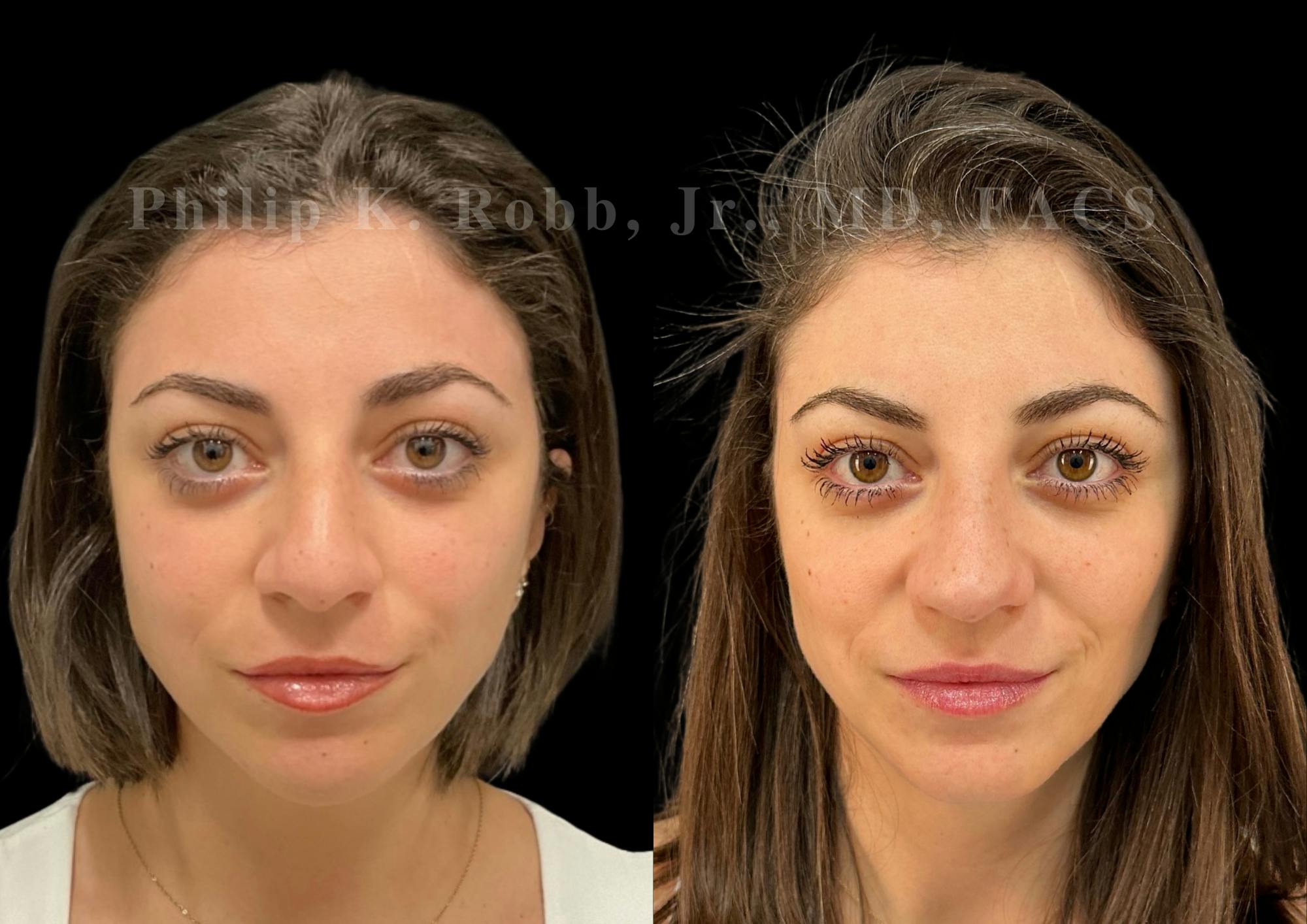 Ultrasonic Rhinoplasty Before & After Gallery - Patient 367906 - Image 3