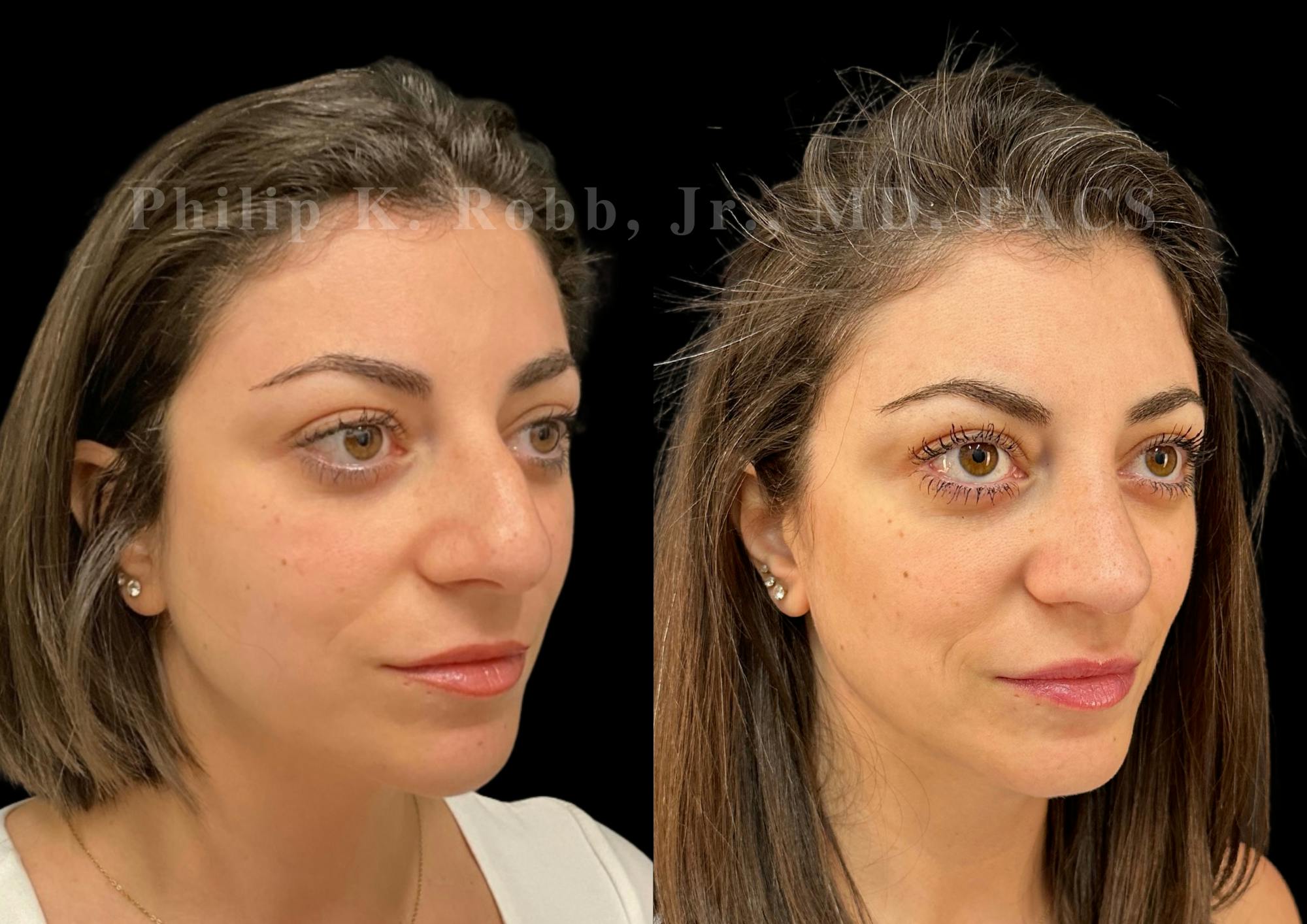 Ultrasonic Rhinoplasty Before & After Gallery - Patient 367906 - Image 2