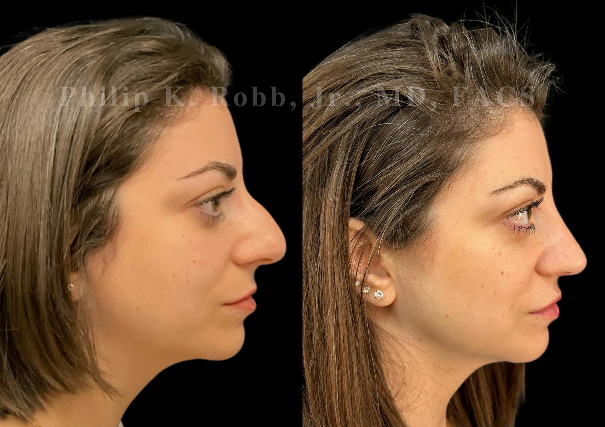 Ultrasonic Rhinoplasty Before & After Gallery - Patient 367906 - Image 1