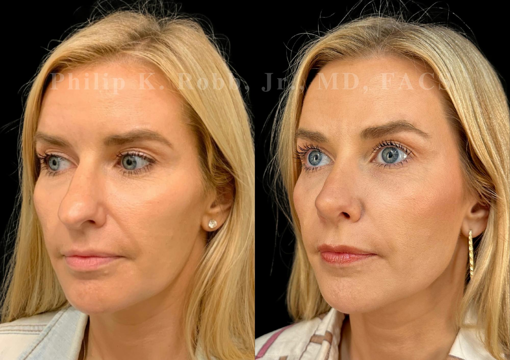 Ultrasonic Rhinoplasty Before & After Gallery - Patient 280239 - Image 4