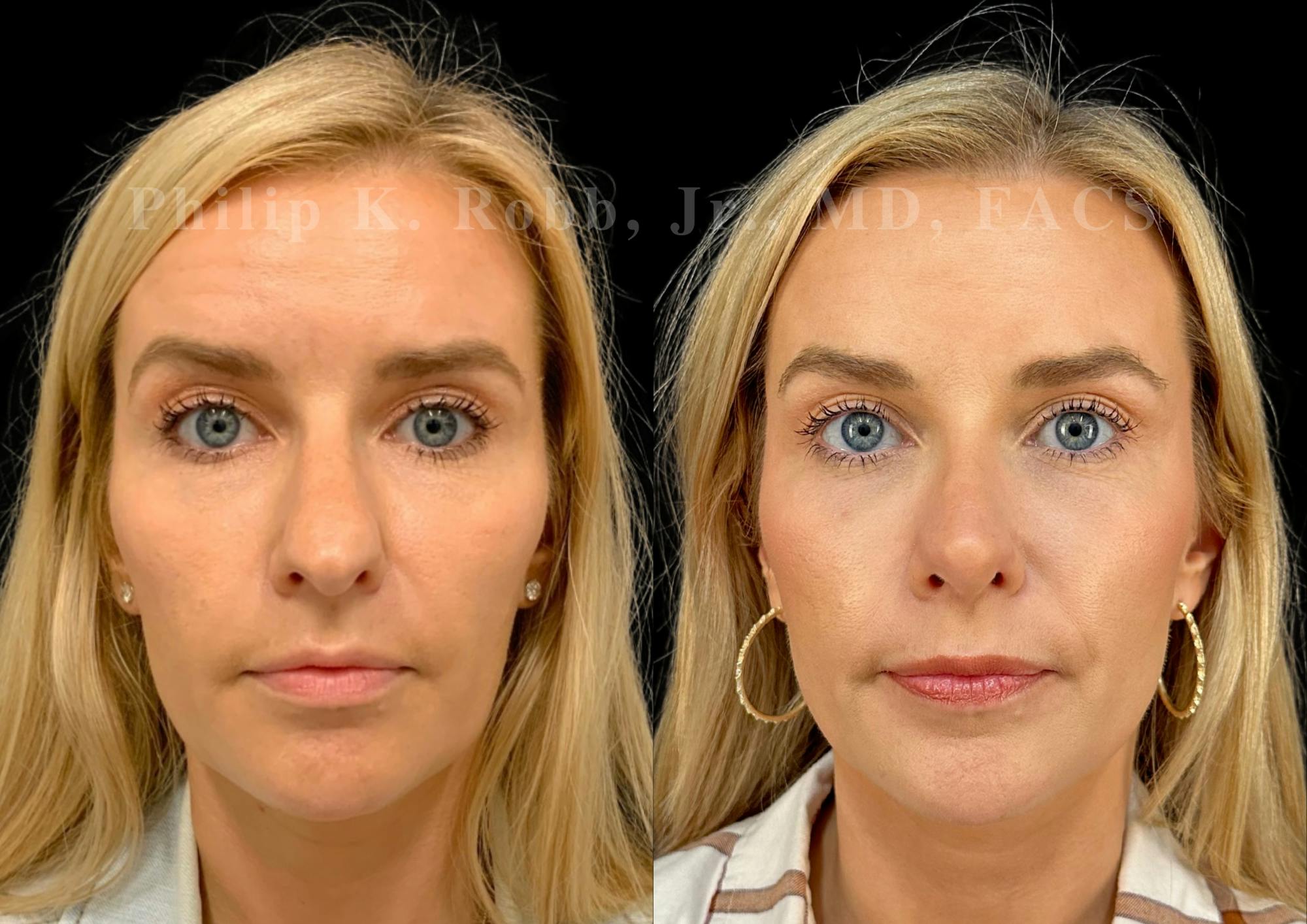 Ultrasonic Rhinoplasty Before & After Gallery - Patient 280239 - Image 3