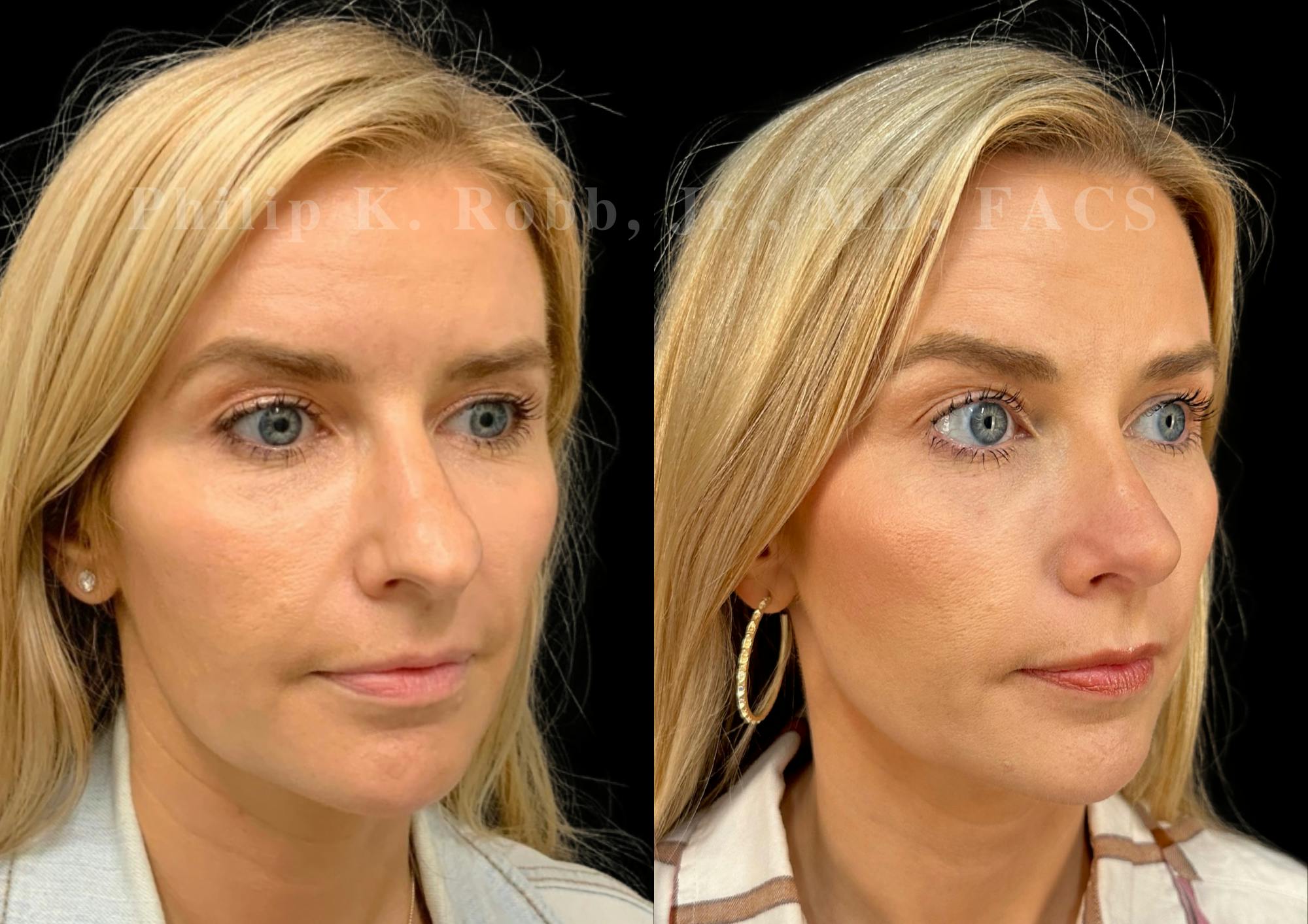 Ultrasonic Rhinoplasty Before & After Gallery - Patient 280239 - Image 2