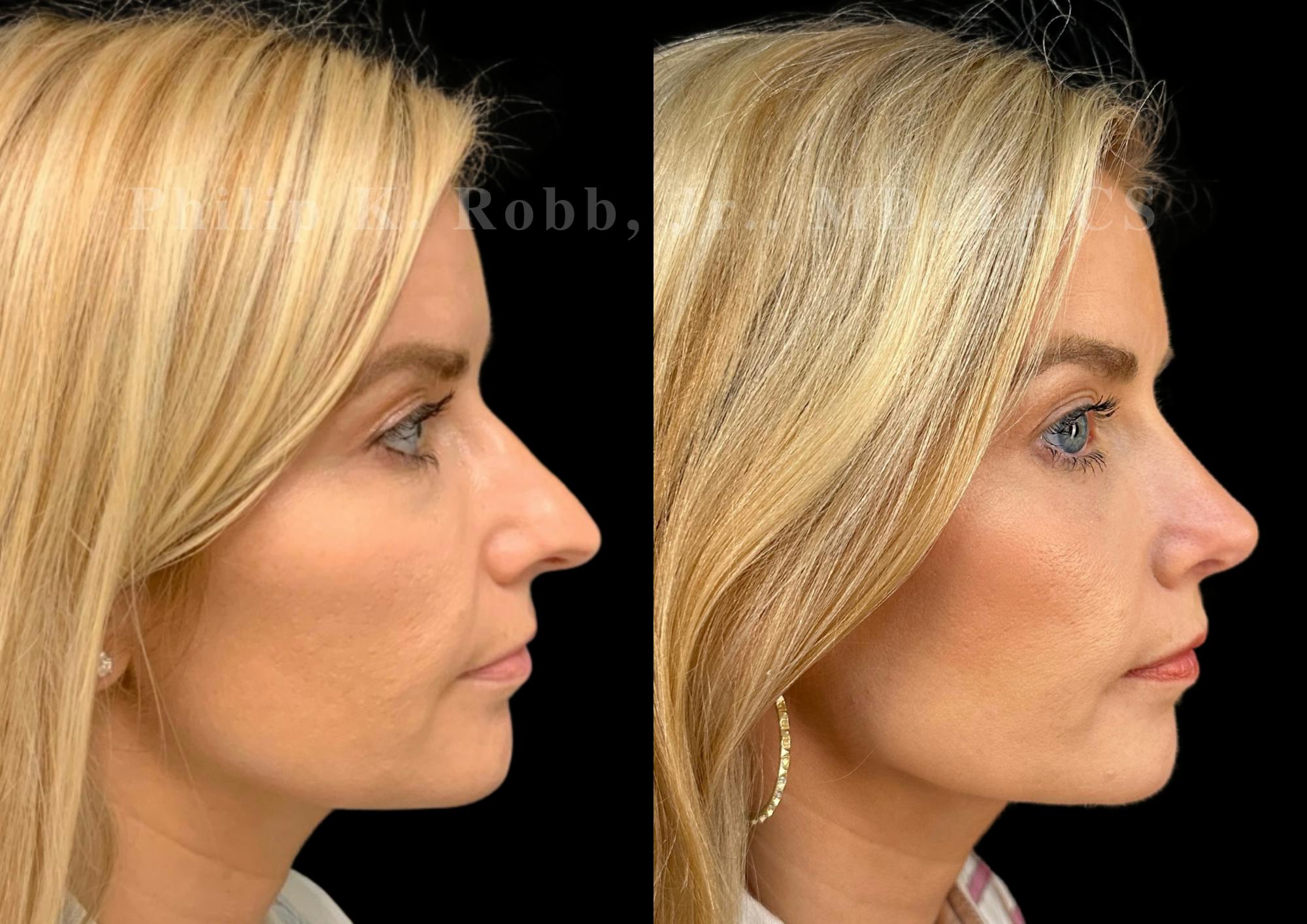 Ultrasonic Rhinoplasty Before & After Gallery - Patient 280239 - Image 1