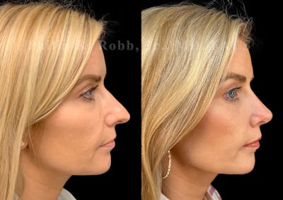 Ultrasonic Rhinoplasty Before & After Gallery - Patient 280239 - Image 1