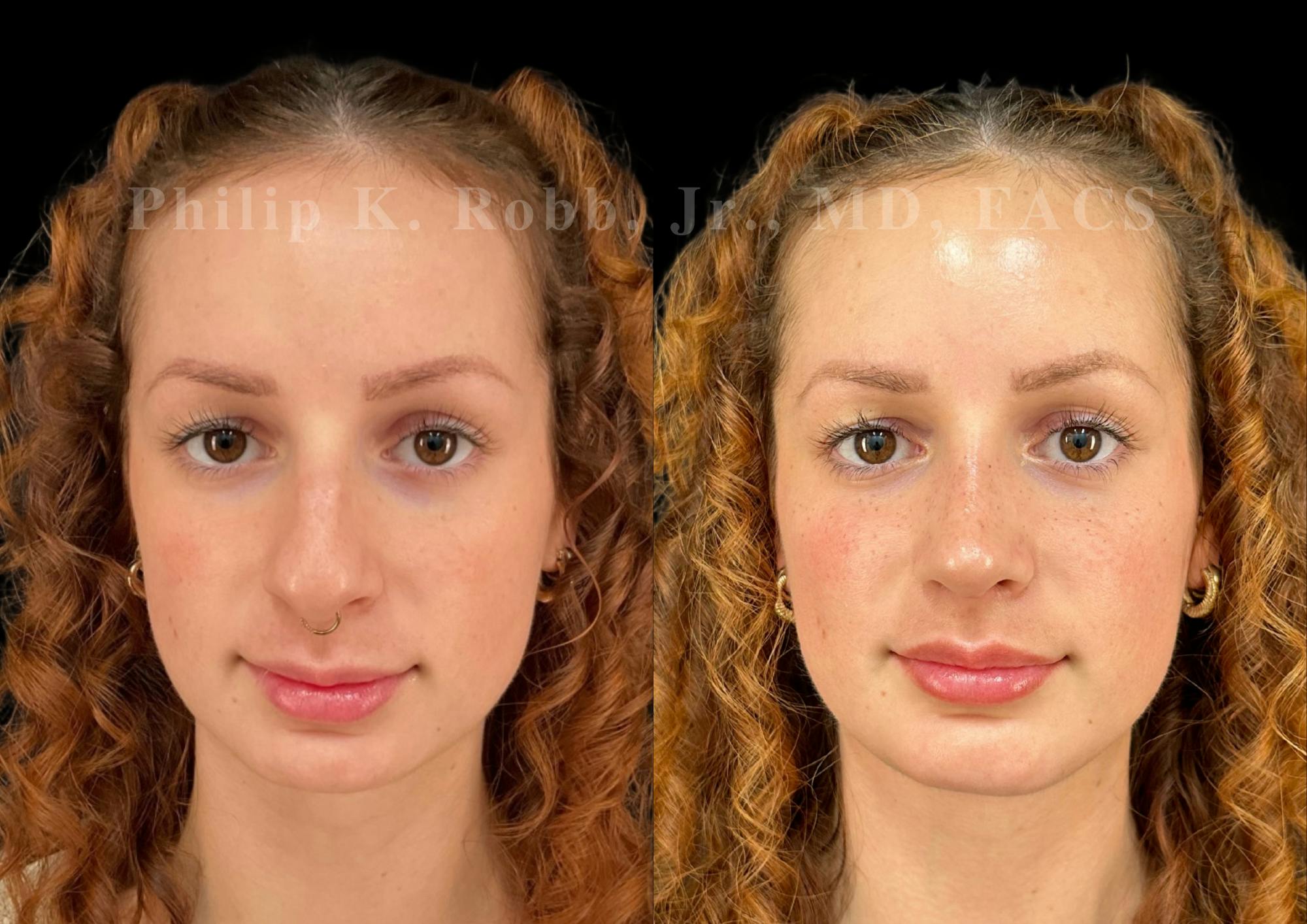 Ultrasonic Rhinoplasty Before & After Gallery - Patient 880769 - Image 3