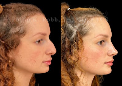 Ultrasonic Rhinoplasty Before & After Gallery - Patient 880769 - Image 1