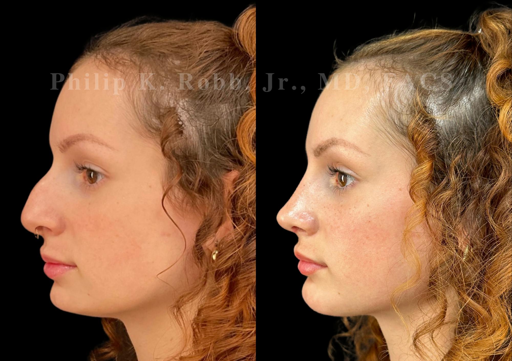 Ultrasonic Rhinoplasty Before & After Gallery - Patient 880769 - Image 5