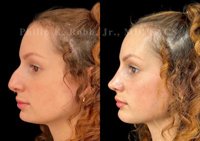 Chin Augmentation Before & After Gallery - Patient 235276 - Image 1