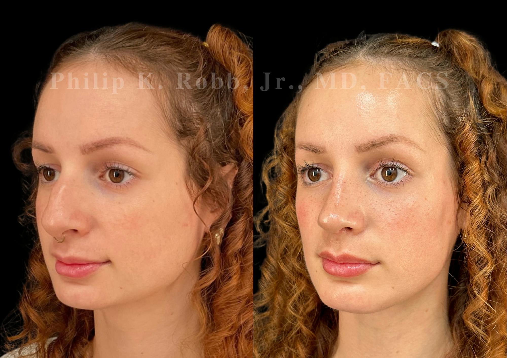 Ultrasonic Rhinoplasty Before & After Gallery - Patient 880769 - Image 4