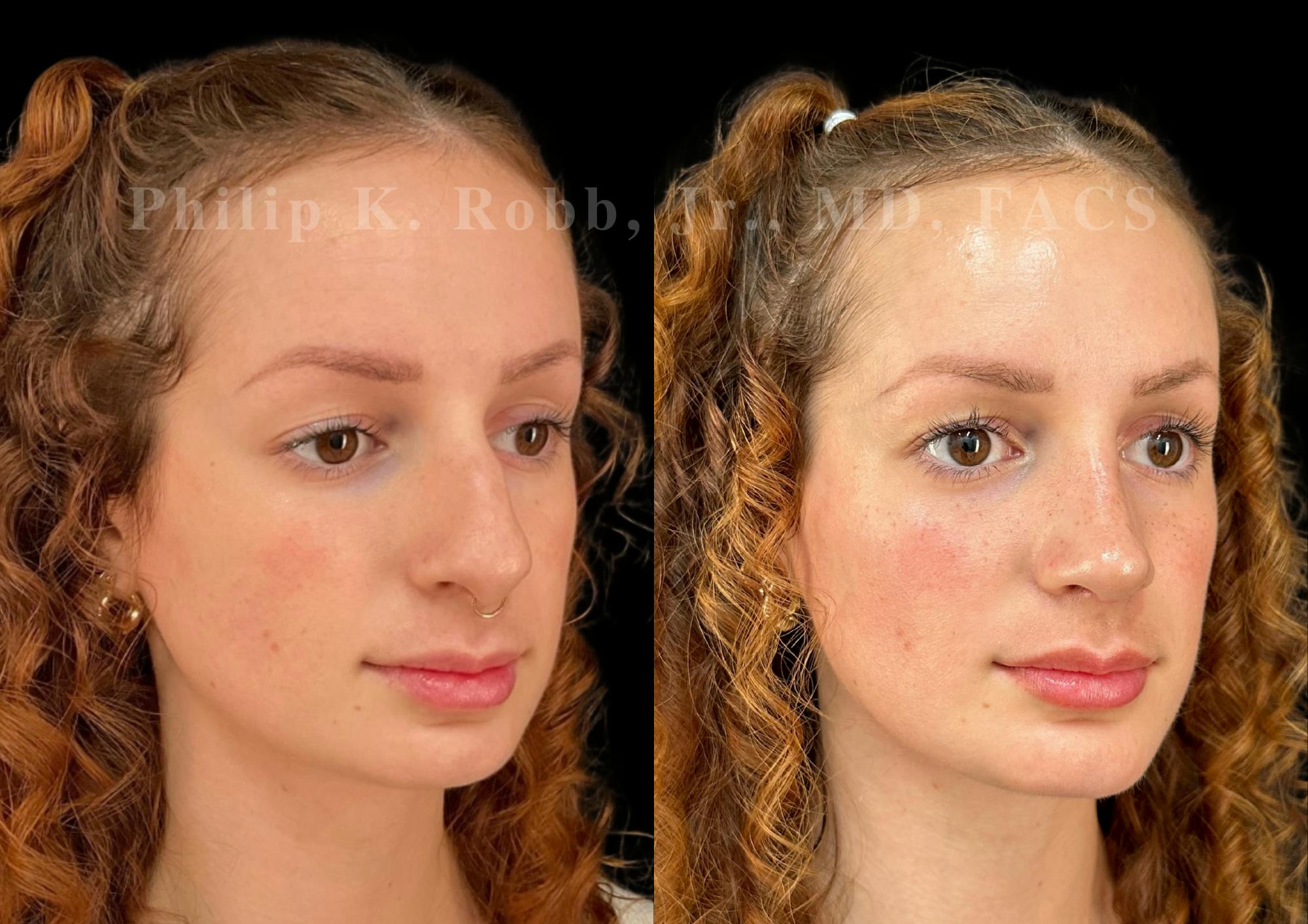 Ultrasonic Rhinoplasty Before & After Gallery - Patient 880769 - Image 2