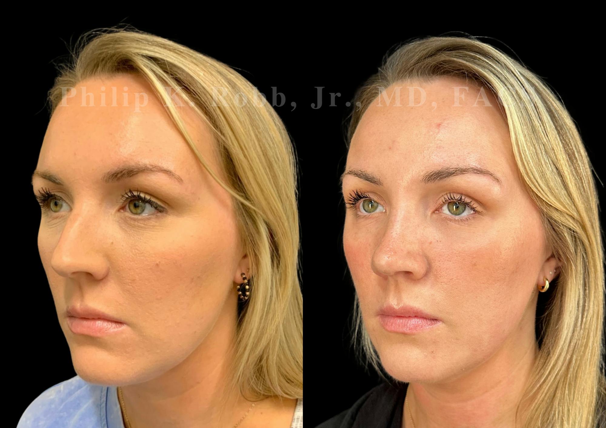 Ultrasonic Rhinoplasty Before & After Gallery - Patient 363348 - Image 4