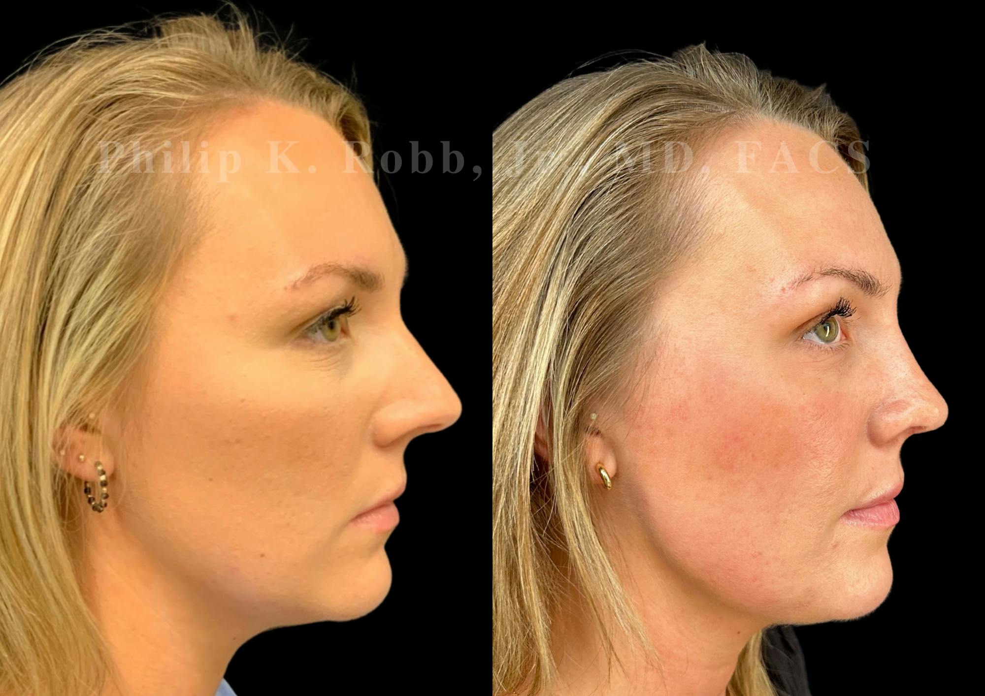Ultrasonic Rhinoplasty Before & After Gallery - Patient 363348 - Image 1