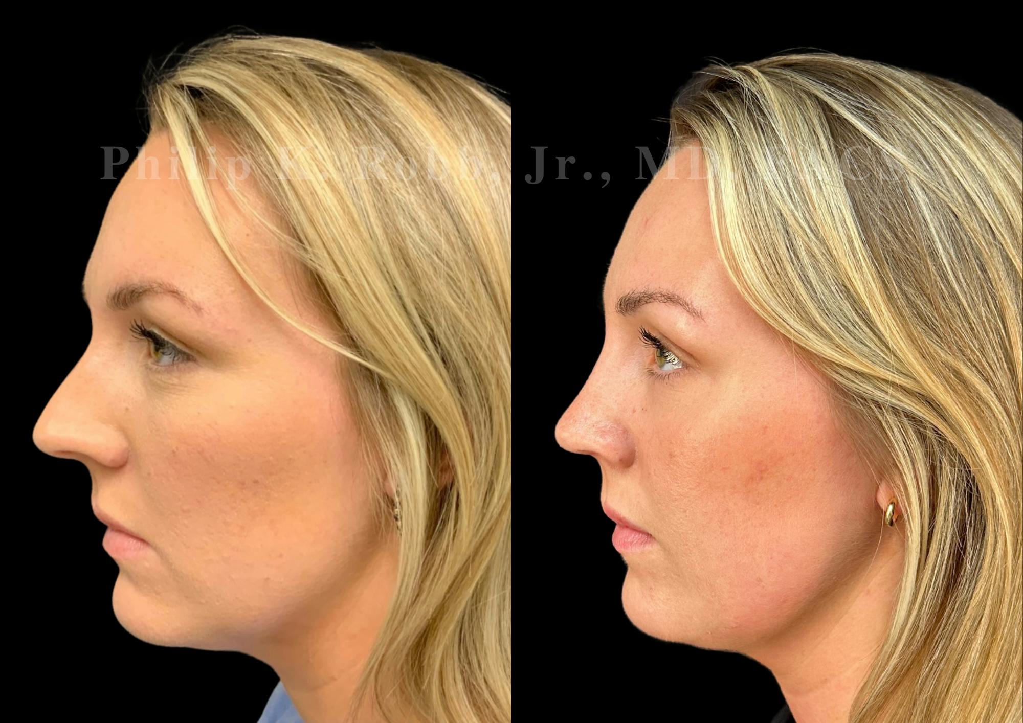 Ultrasonic Rhinoplasty Before & After Gallery - Patient 363348 - Image 5