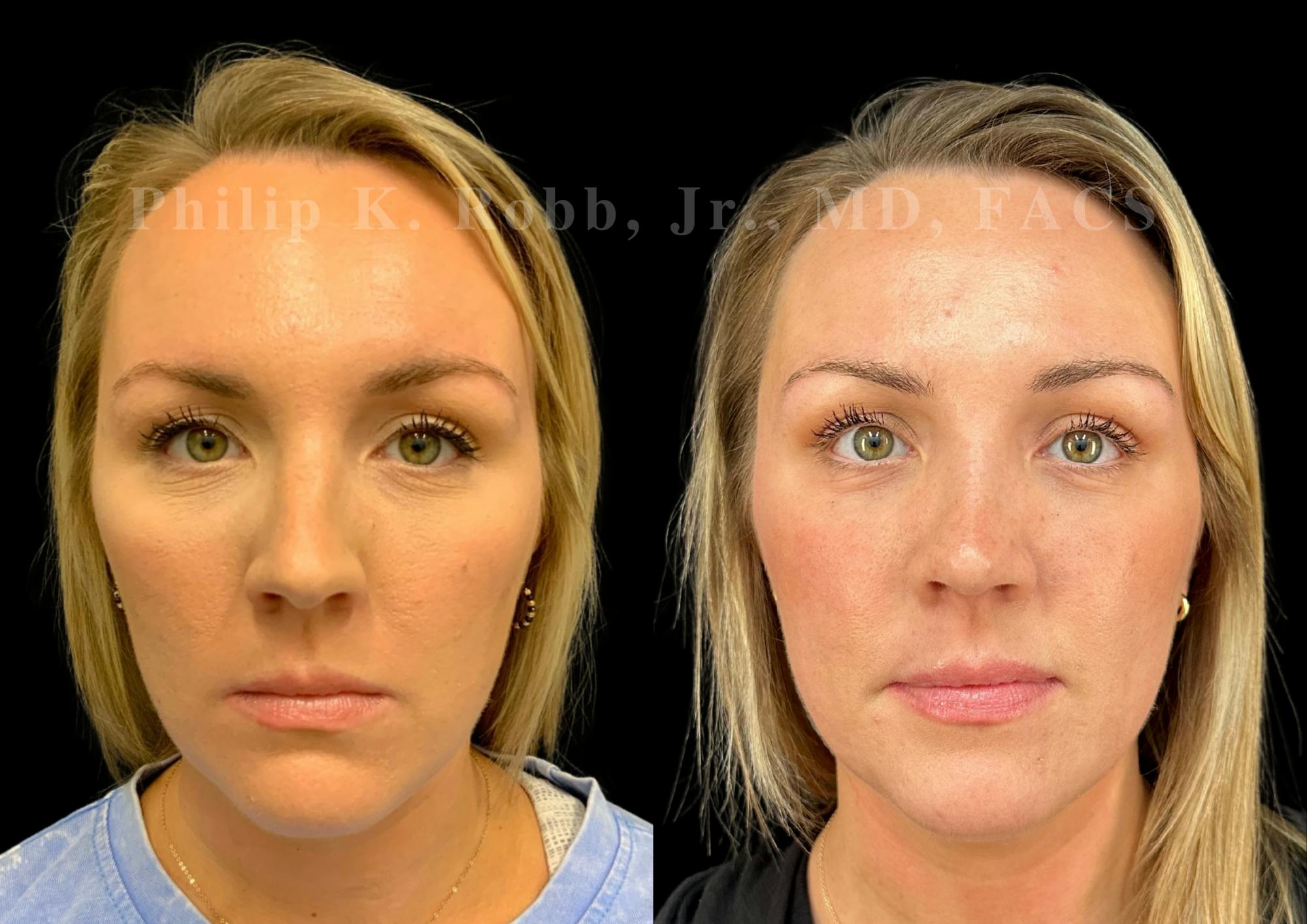 Ultrasonic Rhinoplasty Before & After Gallery - Patient 363348 - Image 3
