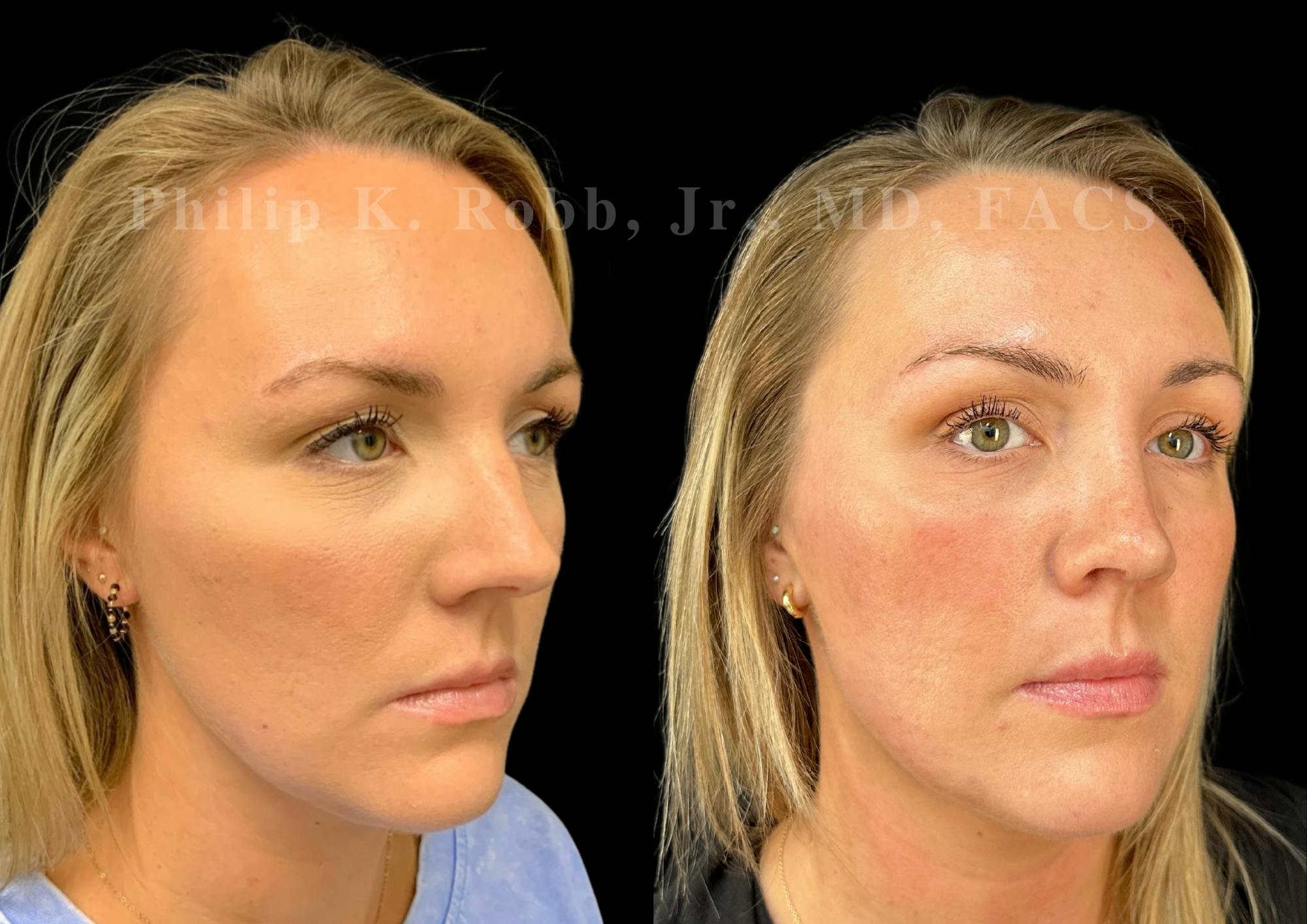 Ultrasonic Rhinoplasty Before & After Gallery - Patient 363348 - Image 2